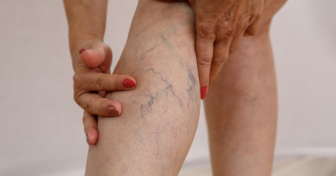 Treatment of Varicose Veins