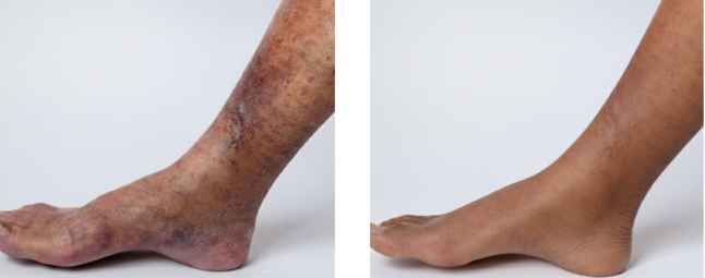Varco Leg Varco Leg Care