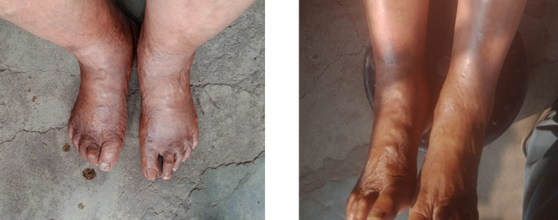 Varco Leg Varco Leg Care